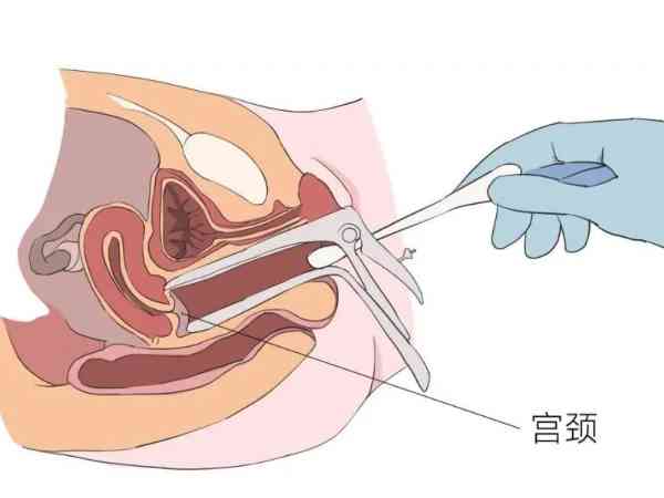 宫腔粘连想通过试管怀孕，首先要注意三点治疗方法！