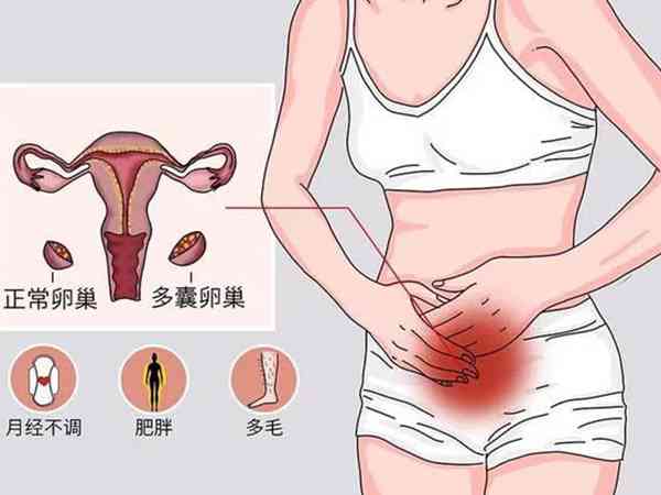多囊卵巢综合症吃坤泰胶囊有原因，有无作用一目了然