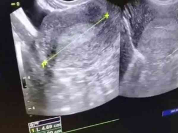 内膜13mm移植冻胚有成功几率，是否容易怀孕还得另说
