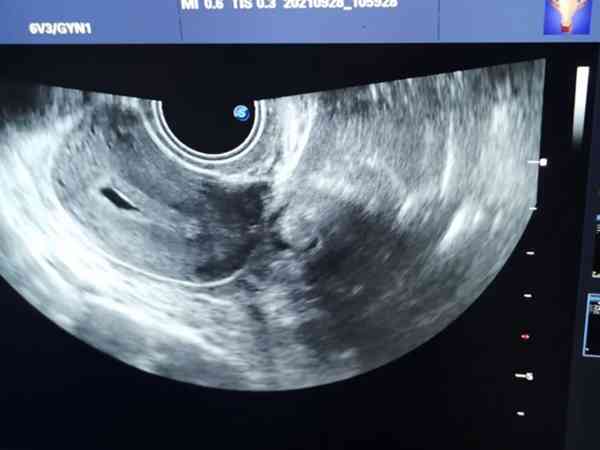 内膜23mm怀孕看不见孕囊不正常！妊娠时间短原因之一