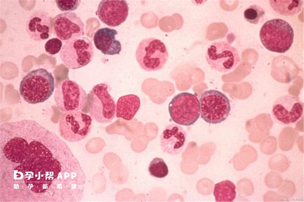 系统性红斑狼疮是一种自身免疫性炎症性结缔组织病