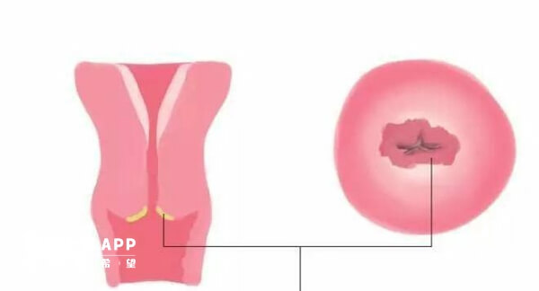 宫颈刮片主要检查宫颈是否有病变