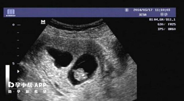 B超可以看见孕囊大小和形状