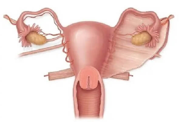 生殖道堵塞会导致子宫腺肌症