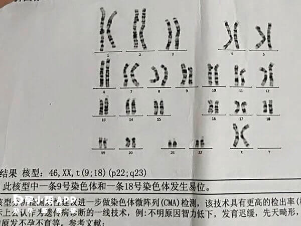 染色体易位的检查报告单