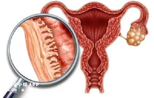 子宫内膜厚度在月经期被分为3个期