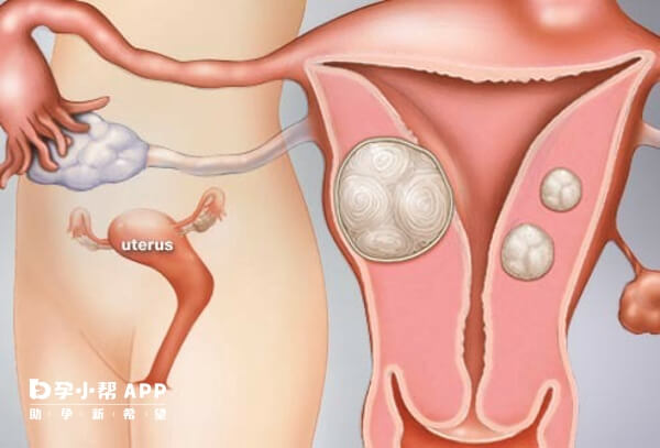 子宫是女性的生育器官