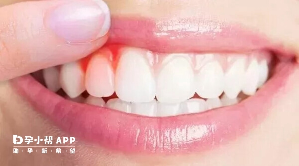 洗牙是利用超声波高频振动