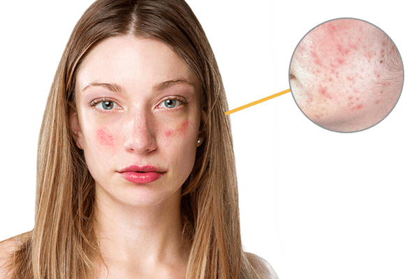 新冠疫苗接种后脸部红痒可能是过敏导致