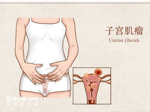 子宫腺肌症早期症状图片