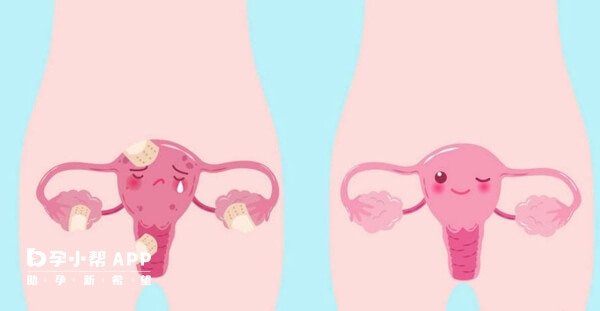 卵巢早衰导致不排卵