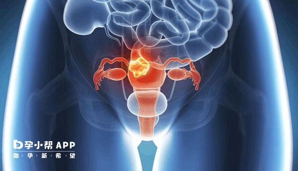 曲普瑞林有抑制卵巢功能的作用