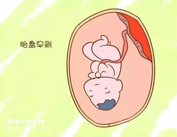 胎盘早剥会导致弥漫性血管内凝血