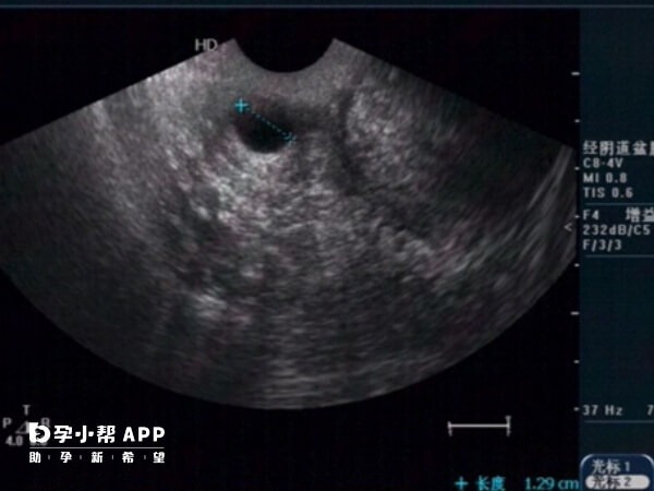 左侧输卵管堵塞不影响怀孕