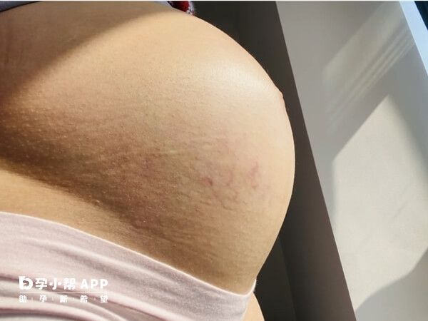 孕29周的妊娠纹样子图