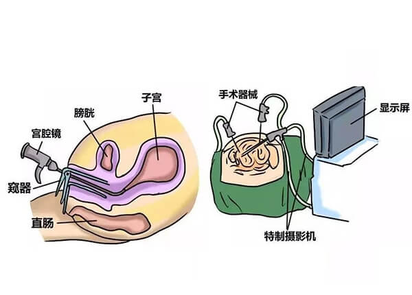 宫腔镜检查过程