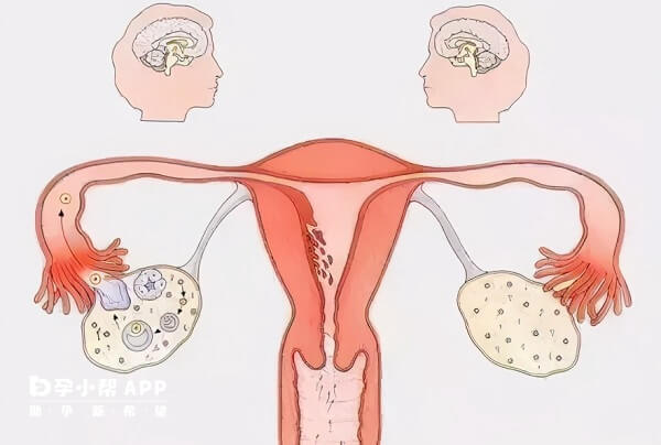 试管移植后子宫可能会出现痉挛症