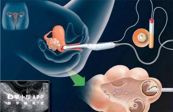胚胎移植手术图解