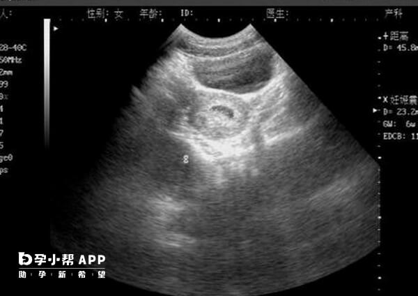 孕早期胚芽