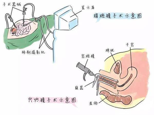 宫腔镜手术过程图