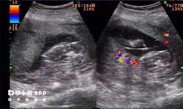 最后怀孕双胞胎