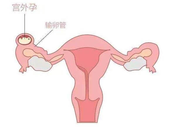 宫外孕导致移植后阴道出血