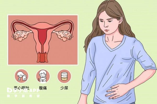 卵巢过度刺激综合征是女性取卵伤害之一