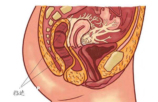 子宫摘除后可能会导致盆腔粘连