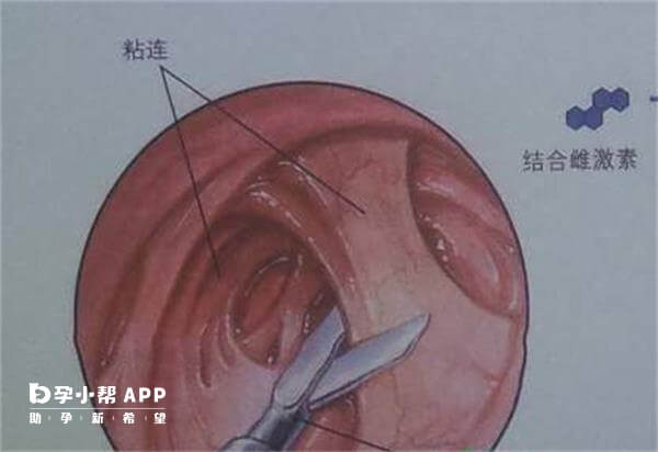 宫腔线分离图片