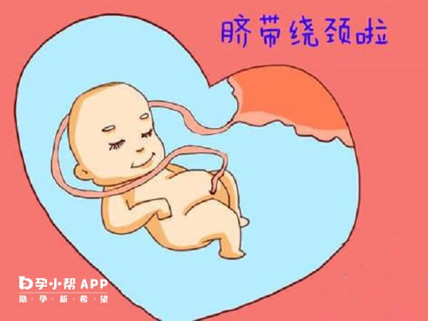 活泼的胎儿容易脐带绕颈