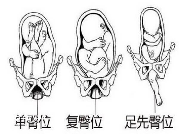 胎儿臀位女儿图片