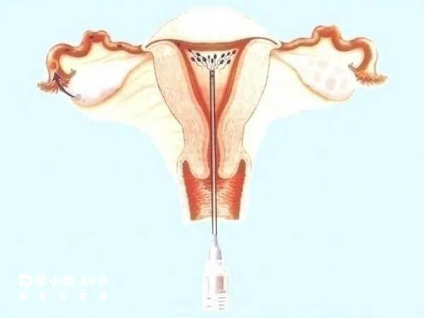 精液是液化前注入注射器