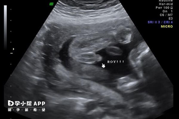 孕16周胎儿生殖器开始逐渐发育