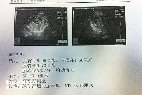 B超检查单看孕囊大小可预测男女