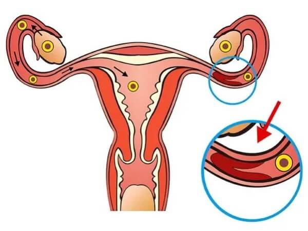 输卵管严重堵塞是需要手术的