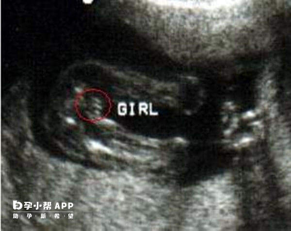 超声男女胎儿鉴别图图片