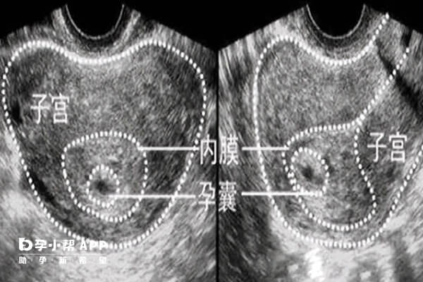 怀孕2个月生男孩胎囊图