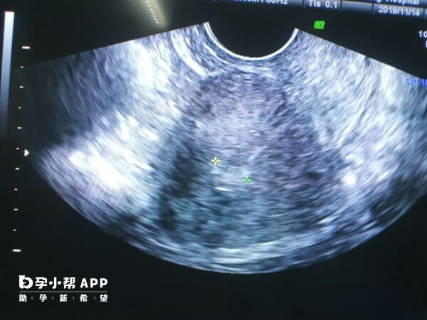 内膜1.6cm不利于移植胚胎
