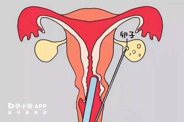 卵巢在子宫下方取卵有困难