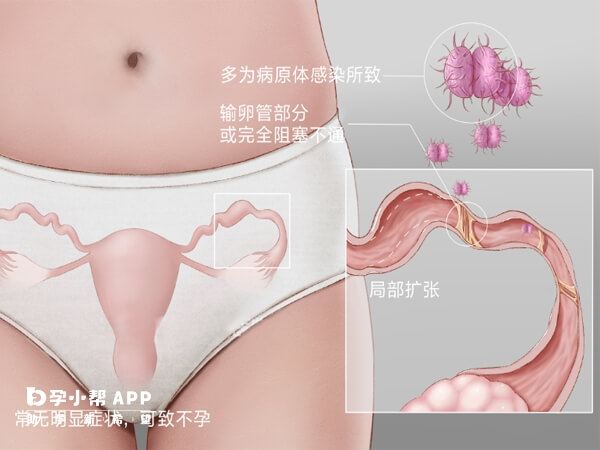 输卵管堵塞会影响正常怀孕