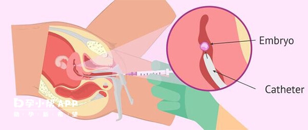 胚胎通过移植管注入到子宫腔内