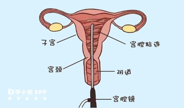 宫腔粘连做试管需要先检查