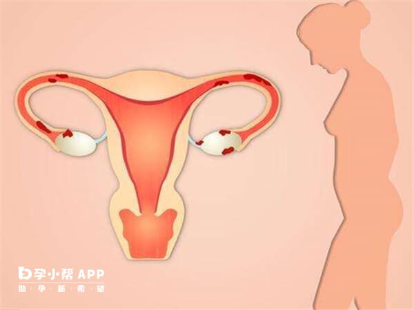 取卵后子宫增大明确诊断后针对性治疗