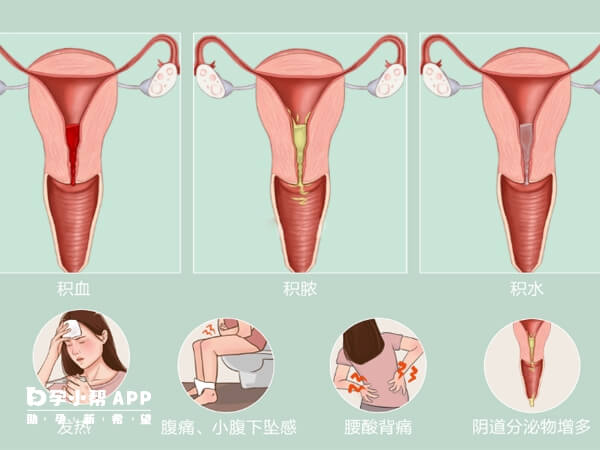 宫腔积液分生理和病理性