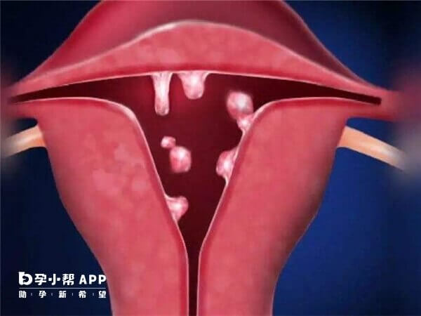 子宫内膜蠕动频率低可以移植