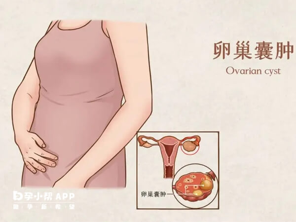 卵巢囊肿分两种情况