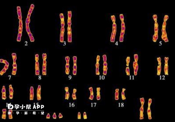 13号染色体异常的情况分多种