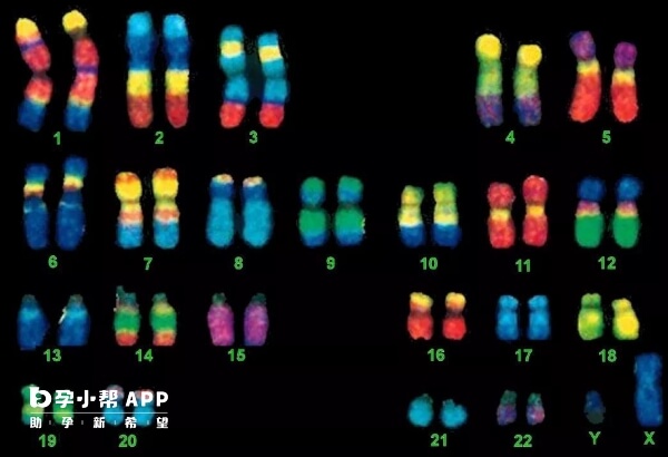 15号染色体异常会导致胎儿畸形