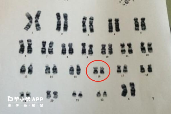 16号染色体异常可能会癌变