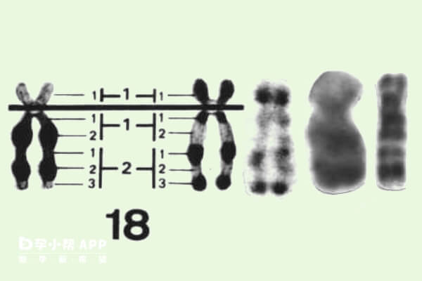 18号染色体